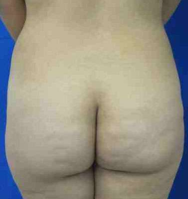 Brazilian Butt Lift Before & After Patient #6766