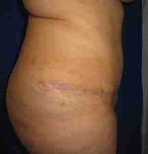 Brazilian Butt Lift Before & After Patient #6769