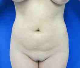 Liposuction Before & After Patient #6772
