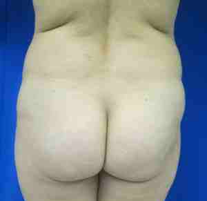 Brazilian Butt Lift Before & After Patient #6775