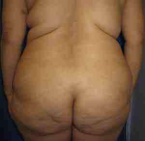 Brazilian Butt Lift Before & After Patient #6778