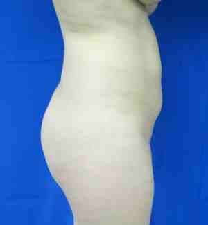 Brazilian Butt Lift Before & After Patient #6781