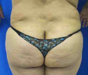 Brazilian Butt Lift Before & After Patient #6784