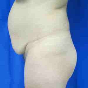 Brazilian Butt Lift Before & After Patient #6787