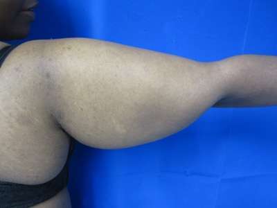 Arm Lift Before & After Patient #5923