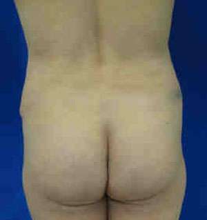 Brazilian Butt Lift Before & After Patient #6790