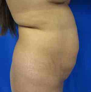 Brazilian Butt Lift Before & After Patient #6793