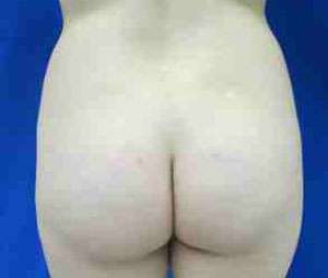 Brazilian Butt Lift Before & After Patient #6796