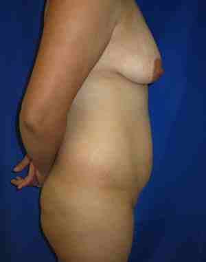 Brazilian Butt Lift Before & After Patient #6799