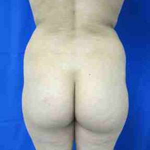 Brazilian Butt Lift Before & After Patient #6804