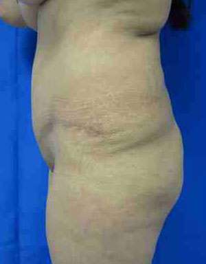 Brazilian Butt Lift Before & After Patient #6814