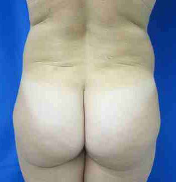 Brazilian Butt Lift Before & After Patient #6819