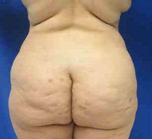 Brazilian Butt Lift Before & After Patient #6822