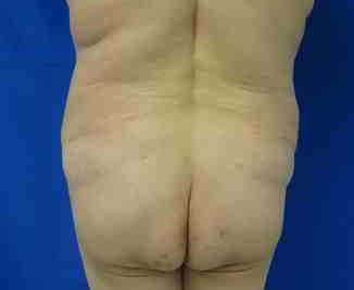 Brazilian Butt Lift Before & After Patient #6825