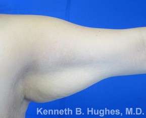 Arm Lift Before & After Patient #5932