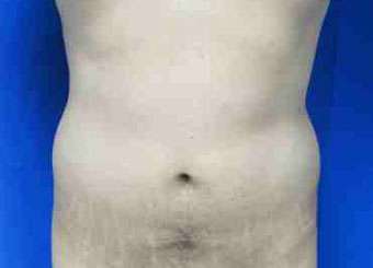 Brazilian Butt Lift Before & After Patient #6830