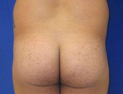 Brazilian Butt Lift Before & After Patient #6835