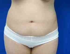 Liposuction Before & After Patient #6838