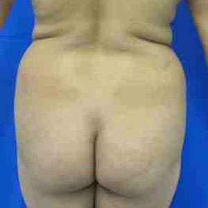 Brazilian Butt Lift Before & After Patient #6844