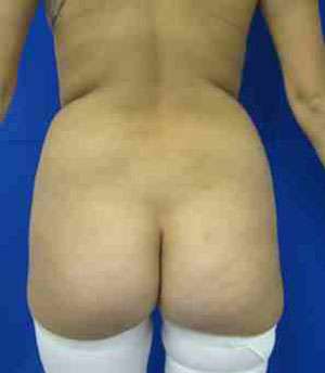Brazilian Butt Lift Before & After Patient #6849