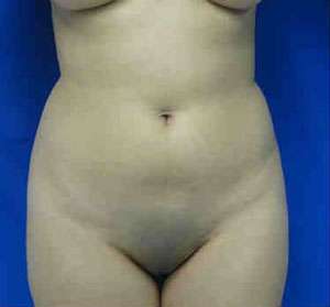 Liposuction Before & After Patient #6852