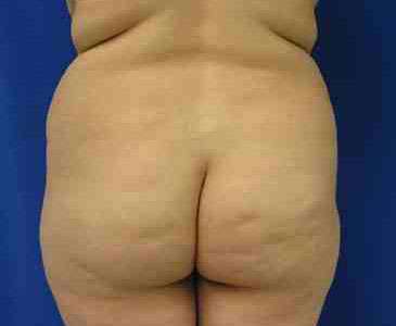 Brazilian Butt Lift Before & After Patient #6855