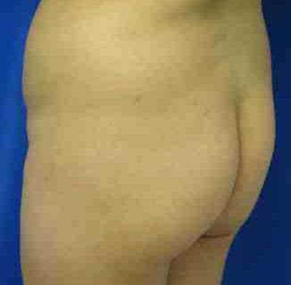 Brazilian Butt Lift Before & After Patient #6860