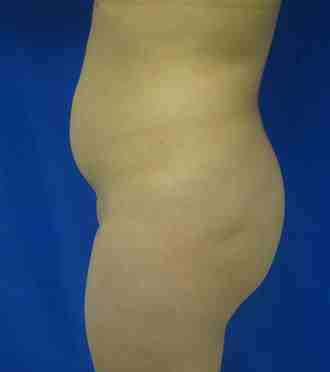 Brazilian Butt Lift Before & After Patient #6863