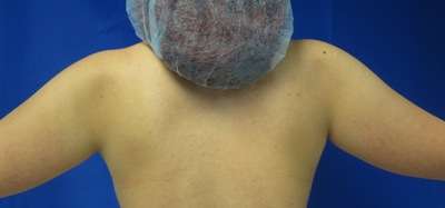 Arm Lift Before & After Patient #5935