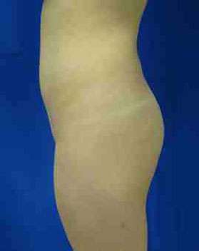 Brazilian Butt Lift Before & After Patient #6873