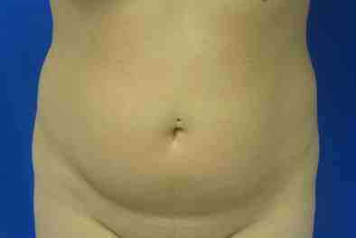 Liposuction Before & After Patient #6889