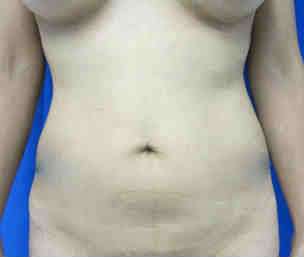 Liposuction Before & After Patient #6892