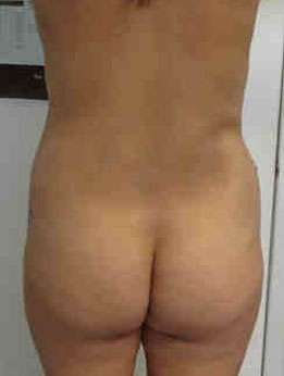 Brazilian Butt Lift Before & After Patient #6895