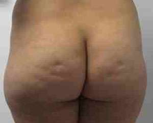 Brazilian Butt Lift Before & After Patient #6898
