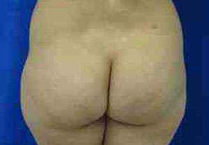 Brazilian Butt Lift Before & After Patient #6903