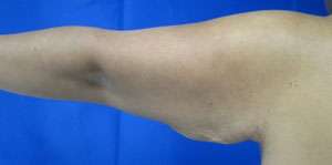 Arm Lift Before & After Patient #5940