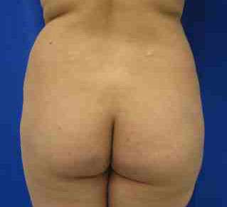 Brazilian Butt Lift Before & After Patient #6906