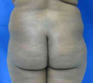 Brazilian Butt Lift Before & After Patient #6909