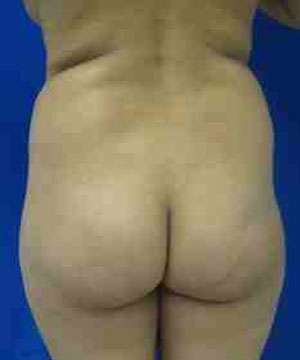 Brazilian Butt Lift Before & After Patient #6914