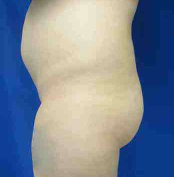Brazilian Butt Lift Before & After Patient #6919