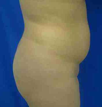 Brazilian Butt Lift Before & After Patient #6922
