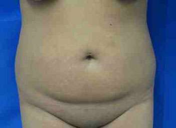 Brazilian Butt Lift Before & After Patient #6935