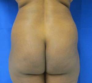 Brazilian Butt Lift Before & After Patient #6940