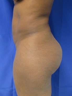 Brazilian Butt Lift Before & After Patient #6948
