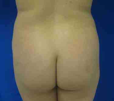 Brazilian Butt Lift Before & After Patient #6957