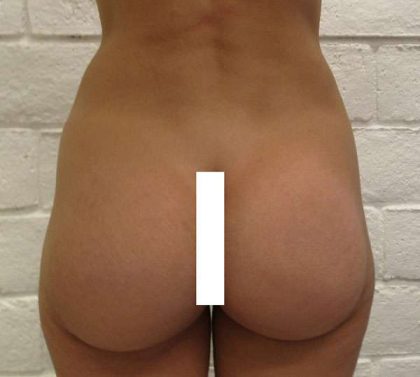 Brazilian Butt Lift for Thinner Patients Before & After Patient #6960