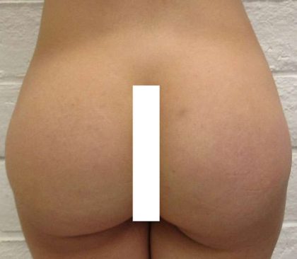 Brazilian Butt Lift for Thinner Patients Before & After Patient #6963