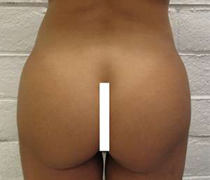 Brazilian Butt Lift for Thinner Patients Before & After Patient #6966