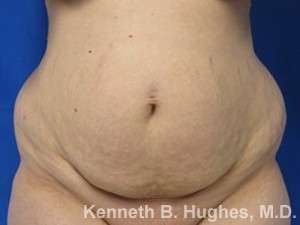 Body Lift Before & After Patient #5956