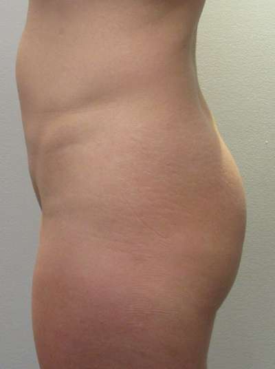 Brazilian Butt Lift for Thinner Patients Before & After Patient #6990
